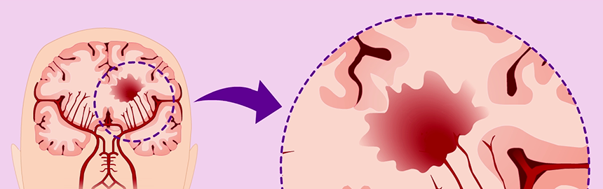 Illustration of brain with a stroke